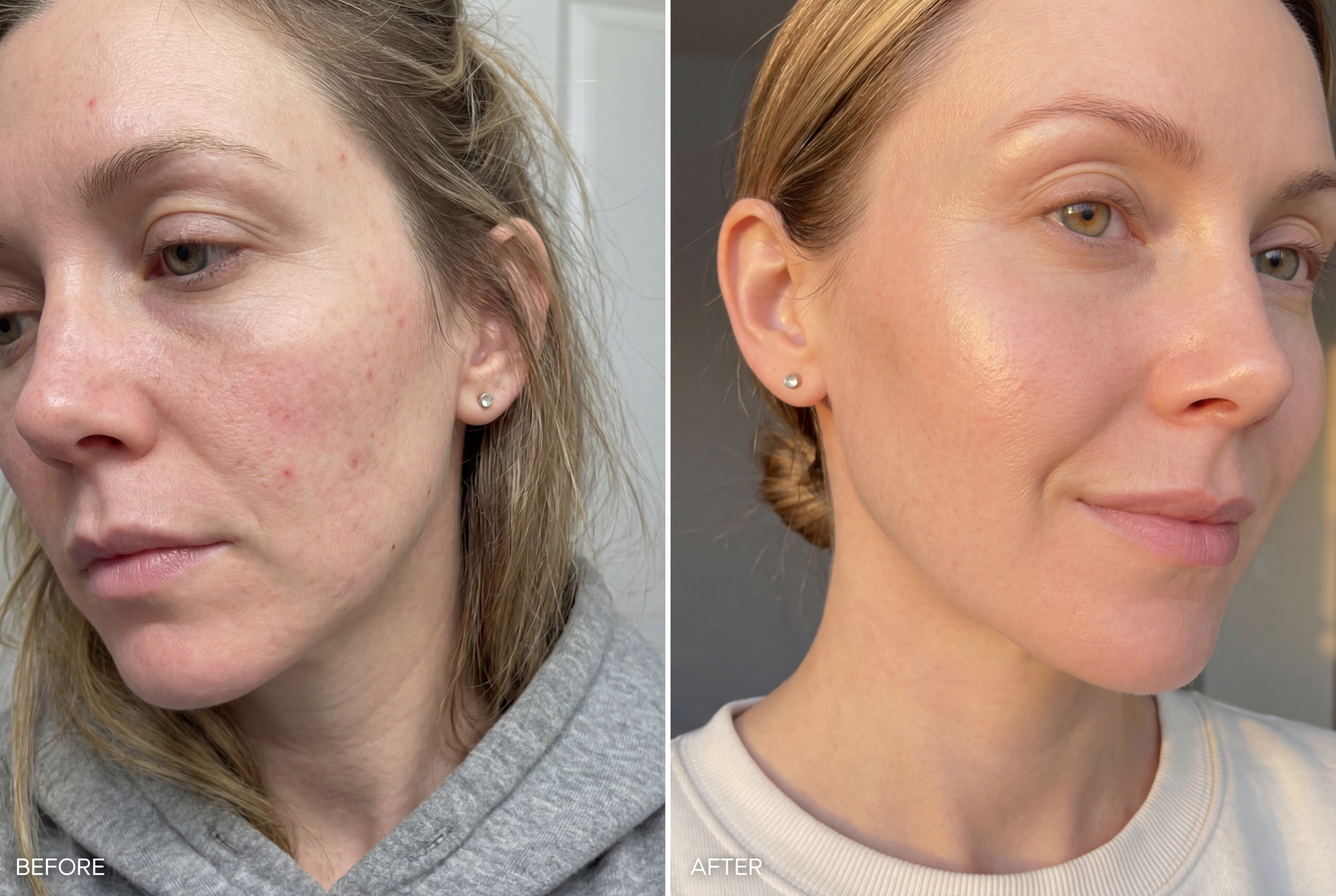 Skin transformation results